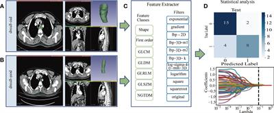Delta-radiomics based on CT predicts pathologic complete response in ESCC treated with neoadjuvant immunochemotherapy and surgery